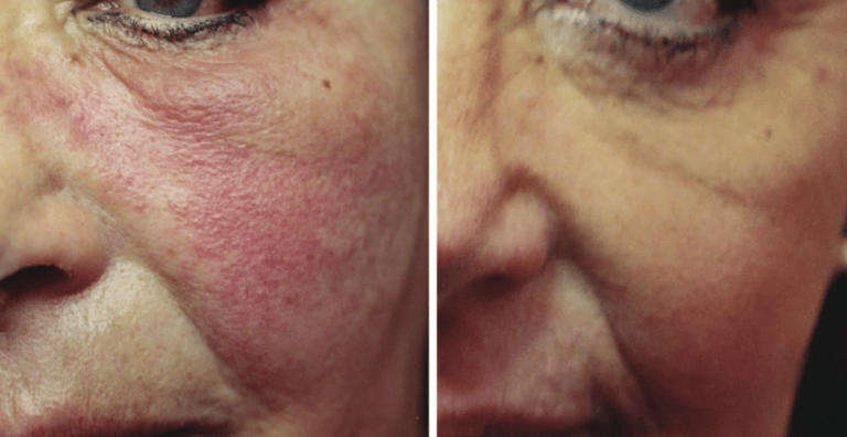 رفع حساسیت به ژل تزریقی: راهنمای مقابله با عوارض ناخوشایند 7 رفع حساسیت به ژل تزریقی: راهنمای مقابله با عوارض ناخوشایند