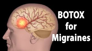 تزریق بوتاکس برای میگرن: نجات از سردردهای آزاردهنده