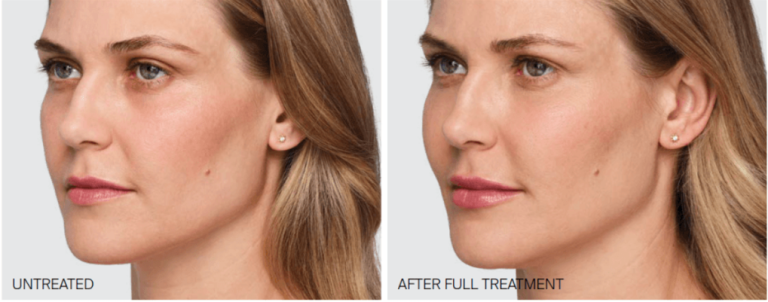 نخ مایع یا جوانساز هیبریدی نسل 4 چیست؟