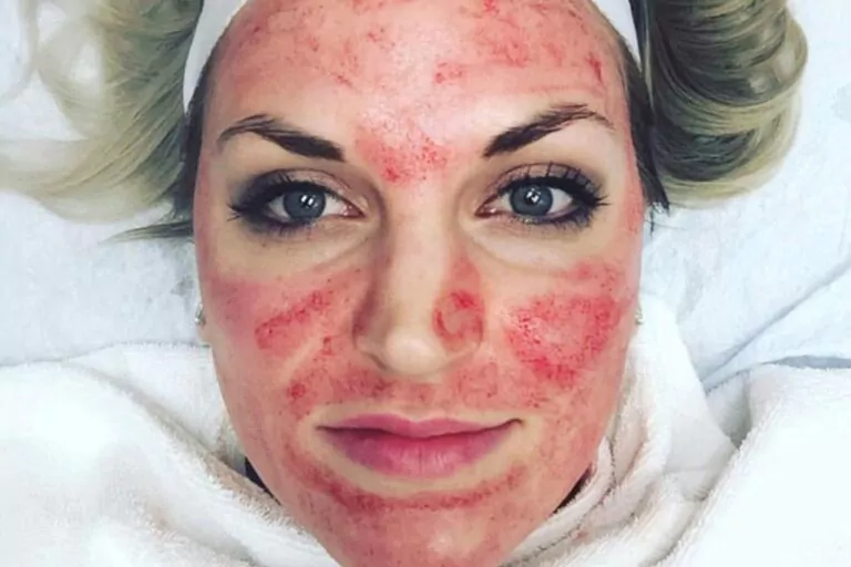 vampire facial 1024x683 min