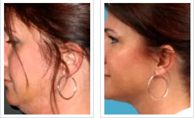 facial mesotherapy before after min.png