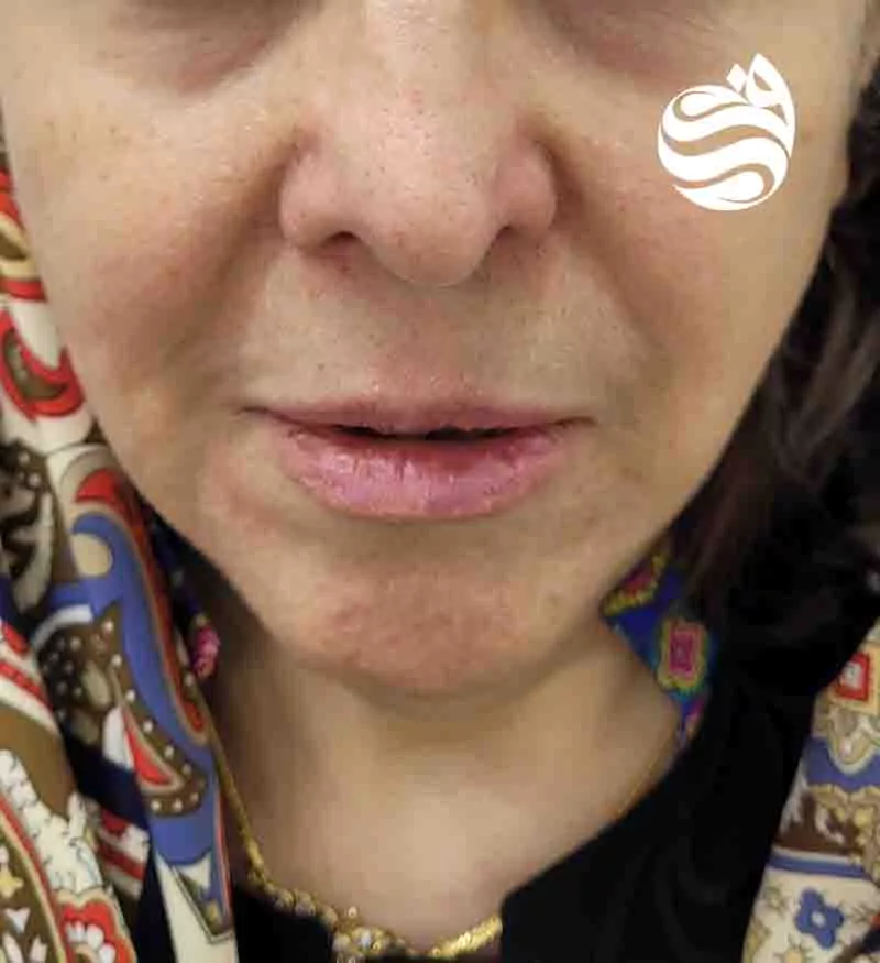 نمونه تزریق ژل در کلینیک دکتر فتوحی