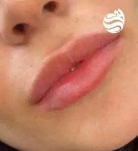 نمونه کار 1 تزریق ژل لب روسی در کلینیک زیبایی دکتر فتوحی