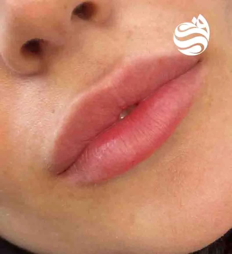 تزریق ژل لب روسی در کلینیک زیبایی دکتر فتوحی