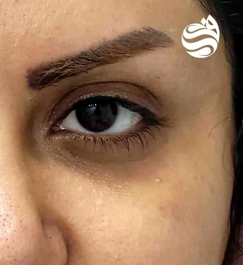 نمونه لیفت ابرو در کلینیک دکتر فتوحی