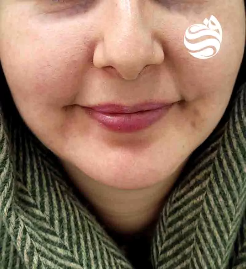 نمونه تزریق ژل در کلینیک دکتر فتوحی