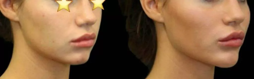 زاویه سازی صورت (کانتورینگ صورت) در شهرک غرب تهران (سعادت آباد) 1 زاویه سازی صورت یا کانتورینگ (facial contouring) چیست؟