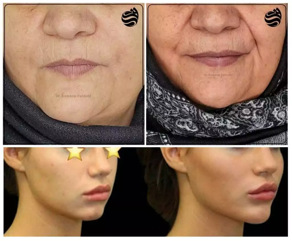 زاویه سازی صورت (کانتورینگ صورت) در شهرک غرب تهران (سعادت آباد) 9 work samples 7 min