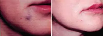 راهنمای کامل رفع ورم بعد از تزریق ژل در نواحی مختلف صورت 3 عوارض جانبی تزریق ژل