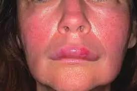 راهنمای کامل رفع ورم بعد از تزریق ژل در نواحی مختلف صورت 2 مقابله با ورم بعد از تزریق ژل