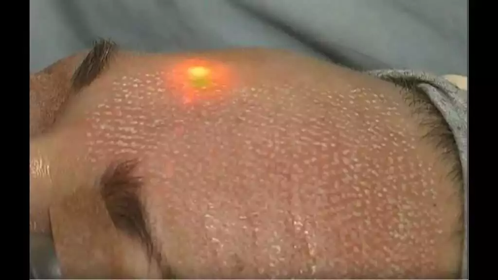 بهترین دستگاه های از بین بردن جای جوش در سال 2024 2 لیزر فرکشنال (fractional laser) در تهران