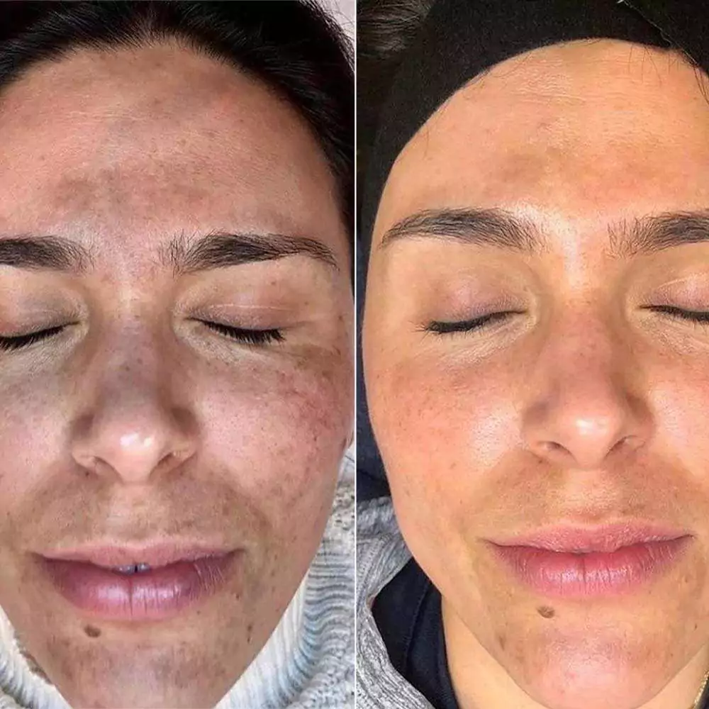 مزایای تزریق مزوژل