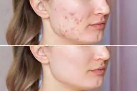 عوارض احتمالی تزریق مزوژل