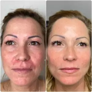رفع حساسیت به ژل تزریقی: راهنمای مقابله با عوارض ناخوشایند 1 علائم هشدار دهنده حساسیت به ژل تزریقی