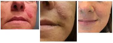 رفع حساسیت به ژل تزریقی: راهنمای مقابله با عوارض ناخوشایند 2 جلوگیری از بروز حساسیت به ژل تزریقی