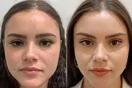 بوتاکس چشم گربه ای چیست: همه آنچه باید درباره این روش جوانسازی بدانید 2 مزایای بوتاکس چشم گربه ای